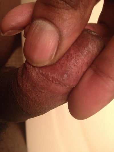 Bumps On Rim Of Penis 85