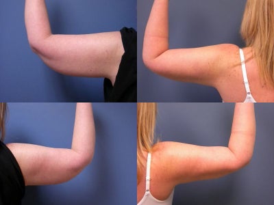 Smart Lipo Of Arms And Neck Raleigh NC.