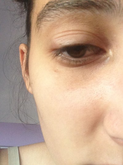 i-have-something-like-a-hard-ball-in-my-upper-eyelid-it-doesnt-hurt-at