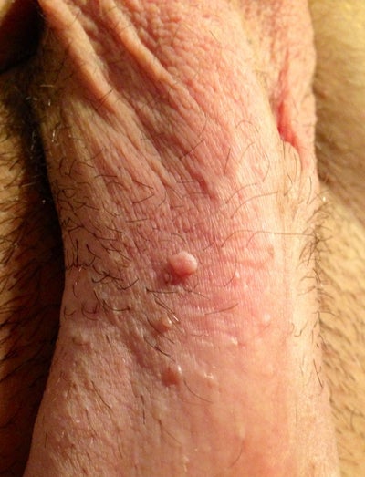 Skin Tag On My Penis 16