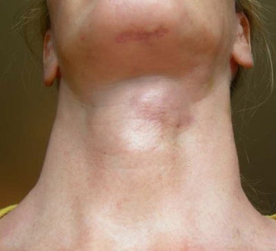 lump in neck that moves