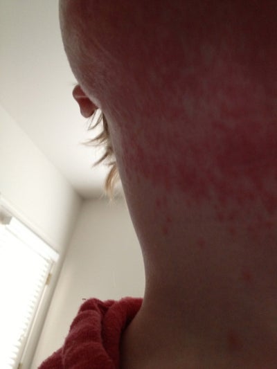 Are Red Bumps on Throat After Sciton Fractional Laser ...