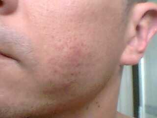 Large Lump with Ingrown Hair After Newfill Doctor Answers Large Lump with Ingrown Hair After Newfill Doctor Answers