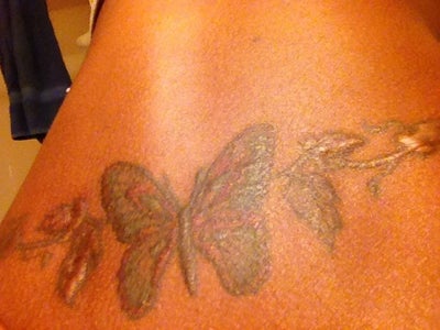 Tattoo Removal with Keloid? (photo) Doctor Answers, Tips