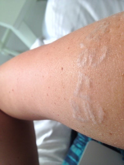 ... to Minimize the Scarring After Tattoo Removal Laser Treatment? (photo