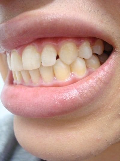 Gaps + Whitening After Braces? (photo) Dentist Answers, Tips