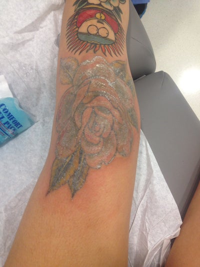 ... Picosure Laser Tattoo Removal on Knee Tattoo - MIAMI, FL - PicoSure