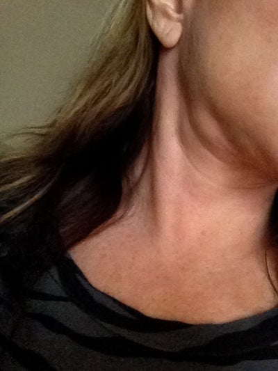 swollen neck lymph nodes one side
