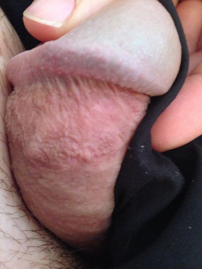 Penis Head Swelling 30
