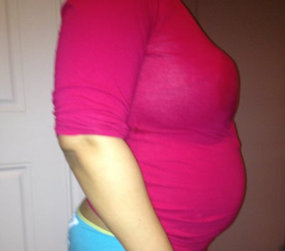 Breast Reduction Results Before And After