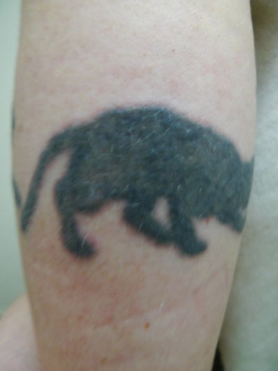 Picosure Tattoo Removal - Sacramento, CA - Tattoo Removal review ...