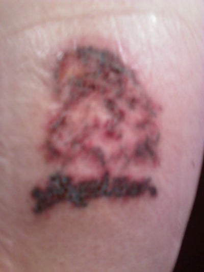 ... Removal for Tattoos - Milwaukee, WI - Tattoo Removal review - RealSelf