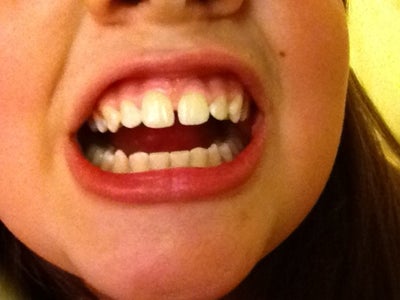 gapped teeth braces