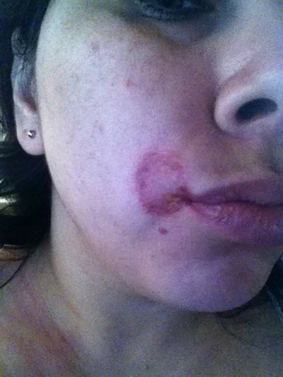 chemical burn on face chemical burn on face