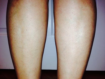 Russian woman suffers burns after hair removal treatment ...
