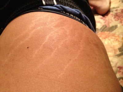 stretch marks before and after