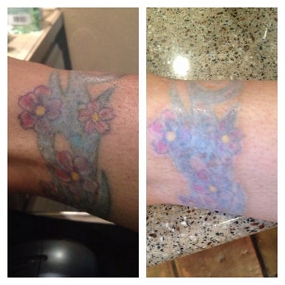 Picosure Tattoo Removal - PicoSure review - RealSelf