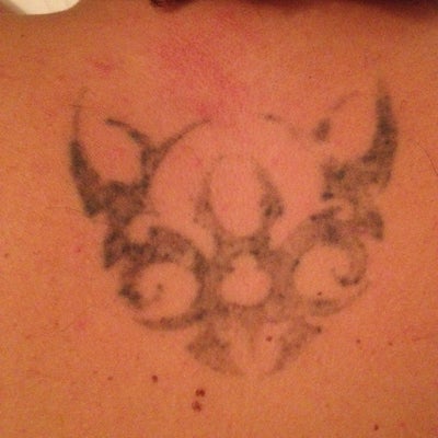 Tattoo Removal in Pictures - London, GB - PicoSure review ...