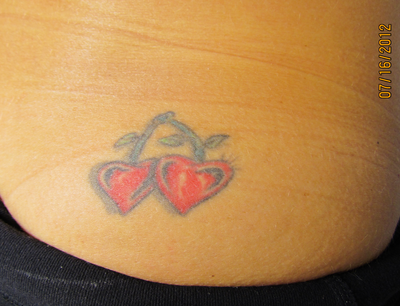 Tattoo Removal in Bellevue, Washington - Tattoo Removal ...