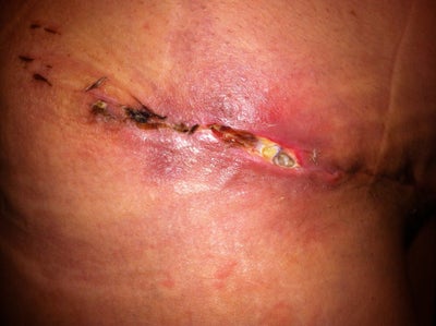 opening tummy tuck incision op weeks why does keep months ago