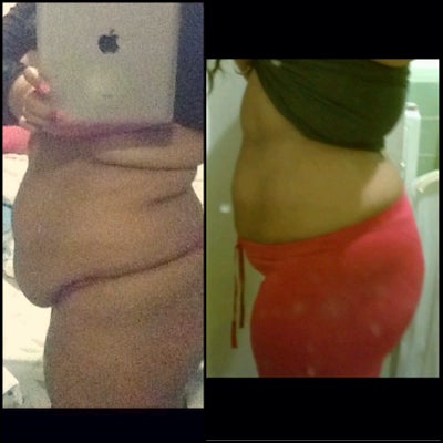 republic dominican bbl lipo before tummy tuck robles realself dra tt loss weight