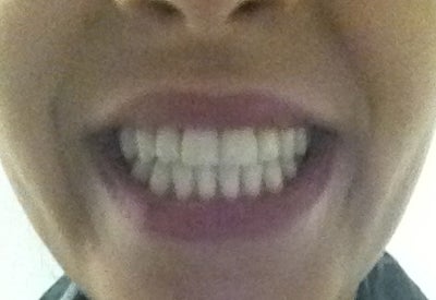 braces wire shifted to one side