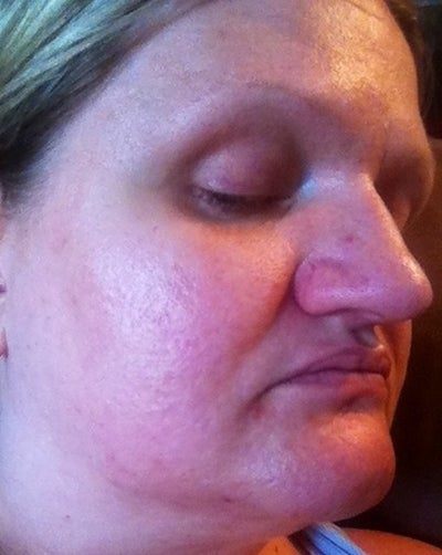 Which treatment would be best for me to remove acne scars ...