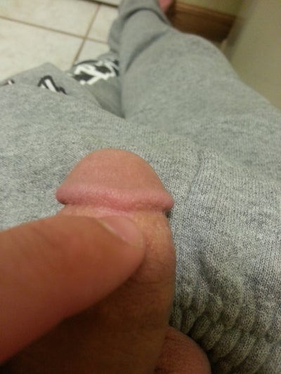 Lump On Tip Of Penis 15