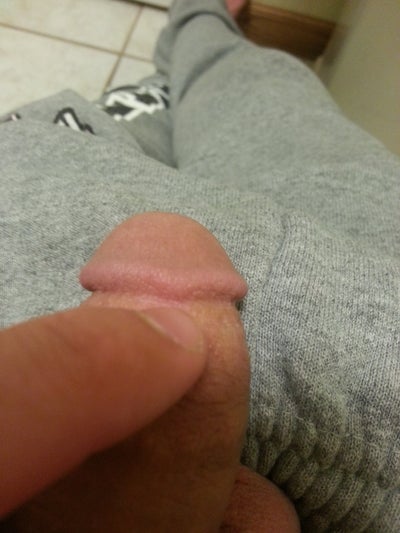 Cyst On Penis Head 27