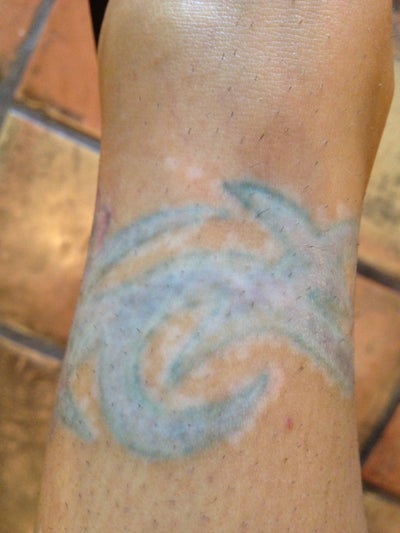 Picosure Tattoo Removal - PicoSure review - RealSelf