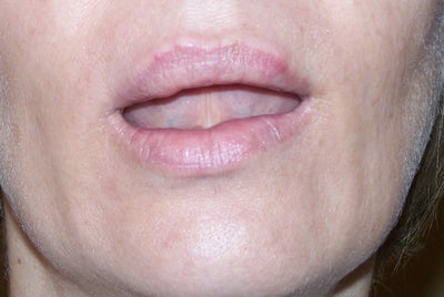 lip lump side juvederm right left wait lumps realself