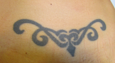 Tattoo Removal in Bellevue, Washington - Tattoo Removal ...