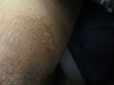 Skin Discoloration on Inner Thighs? (photo) Doctor Answers, Tips