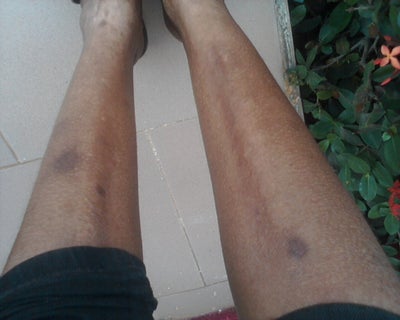 had black spots on my legs since age 15 and I am shy of wearing 