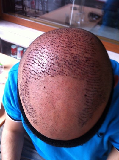 New Hair Restoration Techniques 2013