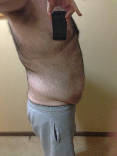 Tummy Tuck After Weight Loss Male