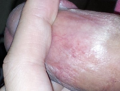 Small Black Dots On Penis 7