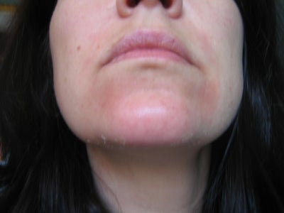 New Skin Revealed- Stressed Skin Got a Cold Sore ...