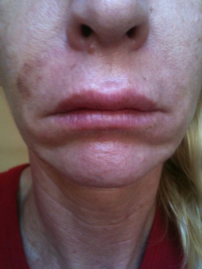 Botox Under Lips to Fix Smoker's Wrinkles Caused \