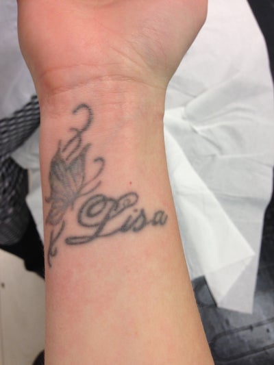 Wrist Tattoo Removal - London, GB - Tattoo Removal review - RealSelf