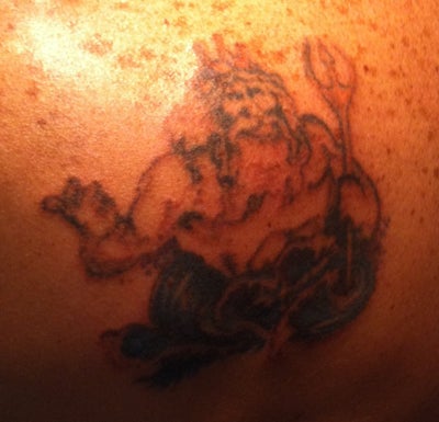 The Beginning of the Long Process of Laser Tattoo Removal - Dallas, TX