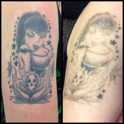 12 Year Old Tattoo Gets the Zap! Brisbane, AU - Tattoo Removal review ...