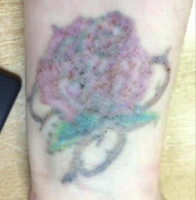 ... think it will take to remove this tattoo? (photo) Doctor Answers, Tips