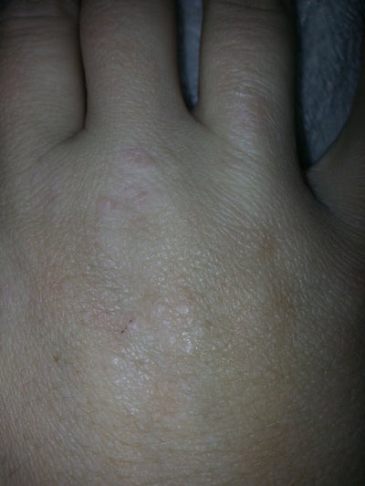 What Are These Small Bumps On The Backs Of My Hands photo Doctor 