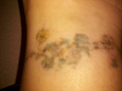 ... the TYPE of Blisters...- Tyler, TX - Tattoo Removal review - RealSelf