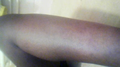 Scars On My Legs From Bug Bites? 18 y/o, African. Doctor Answers, Tips