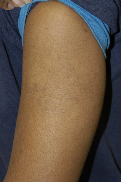 American Tattoo Removal photo from Louis M. DeJoseph, MD, Atlanta ...