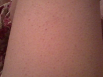 bump on leg i brown bumps on my legs what are they photo doctor answers tips bump on leg i brown bumps on my legs what are they photo doctor answers tips