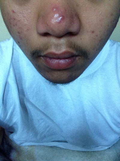 What is the best treatment suited for these raised acne What is the best treatment suited for these raised acne