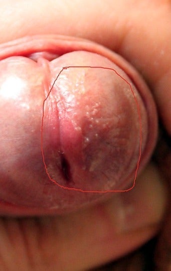 Small White Bumps On Shaft Of Penis 111